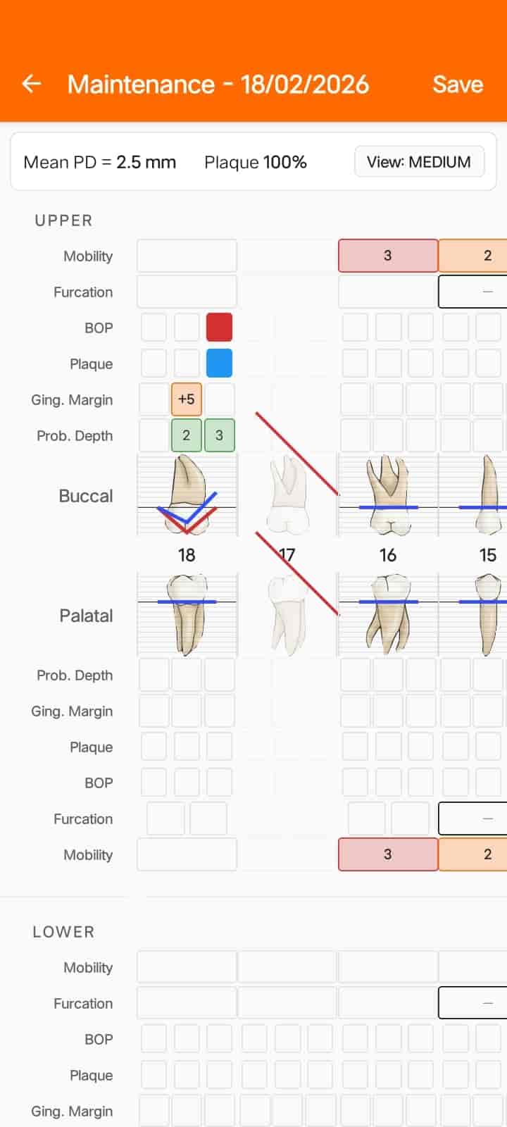 FindClinica mobile app showing the advanced periodontal chart with probing depths, gingival margins and mobility scores per tooth